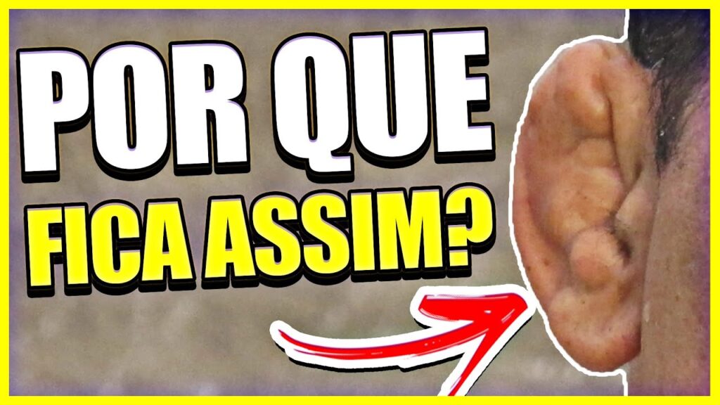 Orelha quebrada no Jiu Jitsu: tem cura? Tratamento e o que fazer